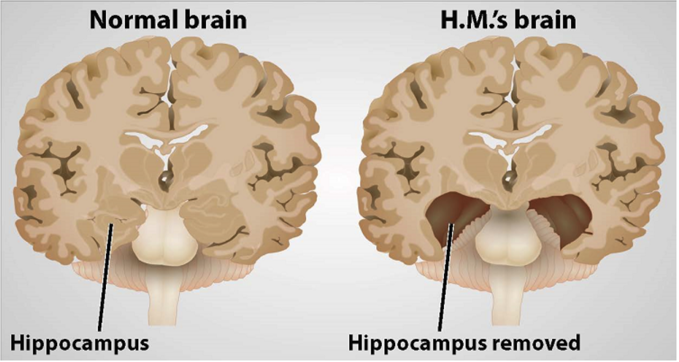 Forget-me-not: The Legacy of Henry Molaison
