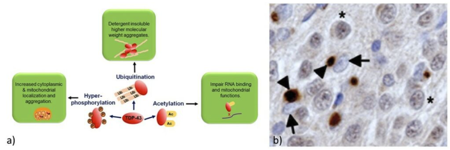 Challenging ALS: From Ice Buckets to Clinical Trials
