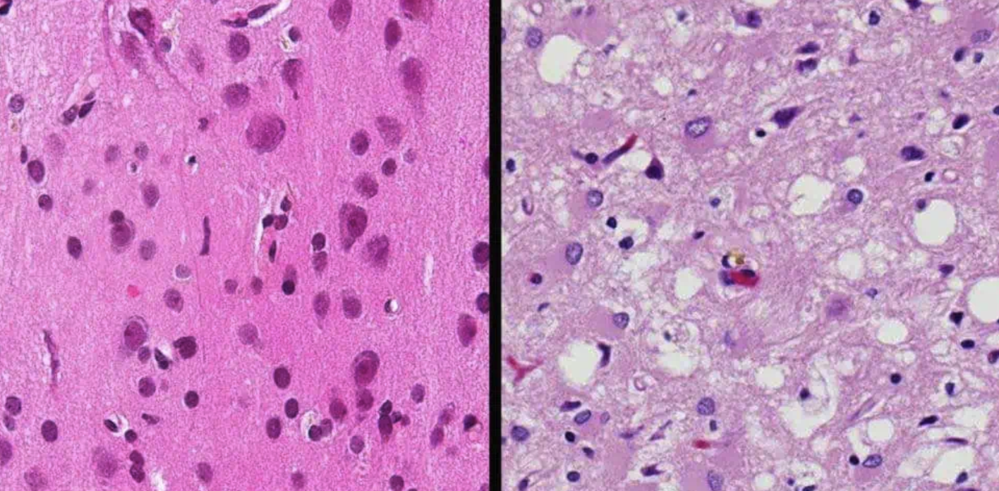 Creutzfeldt-Jakob: the Menace that Kills